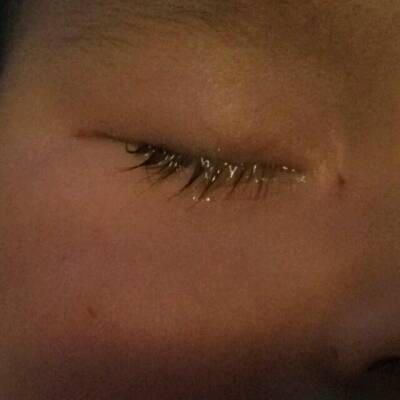 关于宝宝七,八月的时候经常流眼泪,现在一岁了,又经常揉眼睛,请...的信息 关于宝宝七,八月的时候经常流眼泪,现在一岁了,又经常揉眼睛,请...的信息